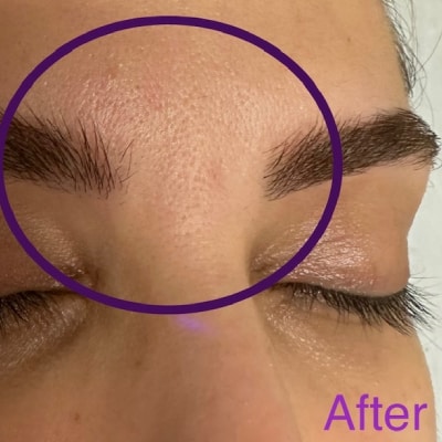 MICROCURRENT FACIAL
